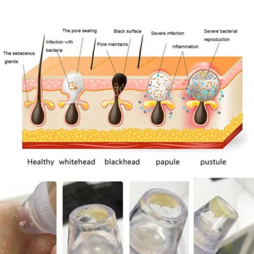 lg_NZPo35gXoh4Gg88rpJEvNjYOJYQ2NEfGm7qPJq6N Kemei KM-8050 5 In 1 Electric Blackhead Remover