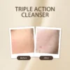 Soft Touch Triple Action Cleanserb - 75ml